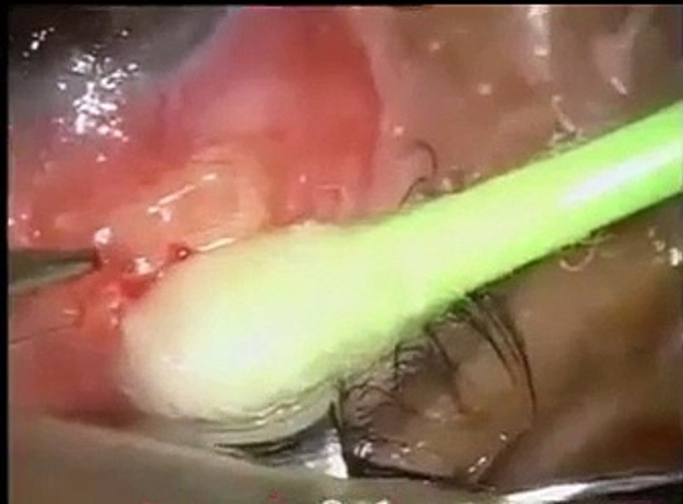 Live Eye Operation