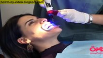 تبيض الأسنان بالليزر,اسرع الوسائل لتبيض الاسنان