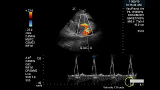 Popular Videos - Renal artery & Duplex ultrasonography