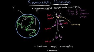 Symptoms of Kawasaki Disease -- The Doctors
