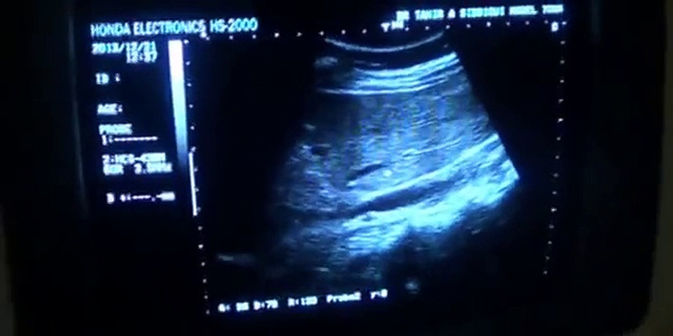 ⁣Renal Artery Doppler - Case Study