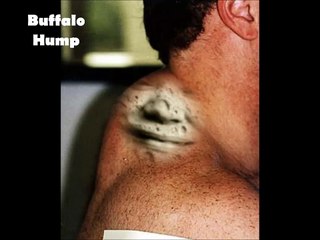 Popular Videos - Cushings syndrome