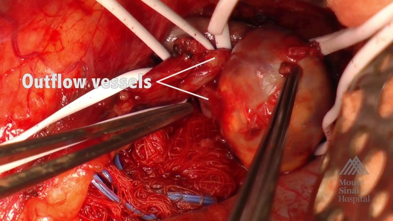 The Mount Sinai Surgical Film Atlas: Endovascular Repair of an Abdominal Aortic Aneurysm