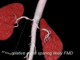 Renal Artery Stenosis