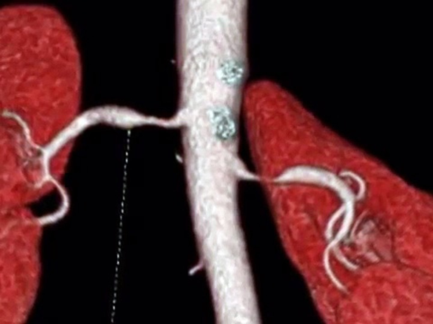 Renal Artery Stenosis