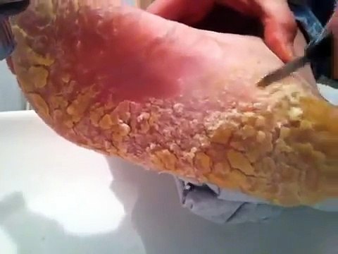 Tiene le scarpe per 4 mesi, guardate come gli diventa il piede!