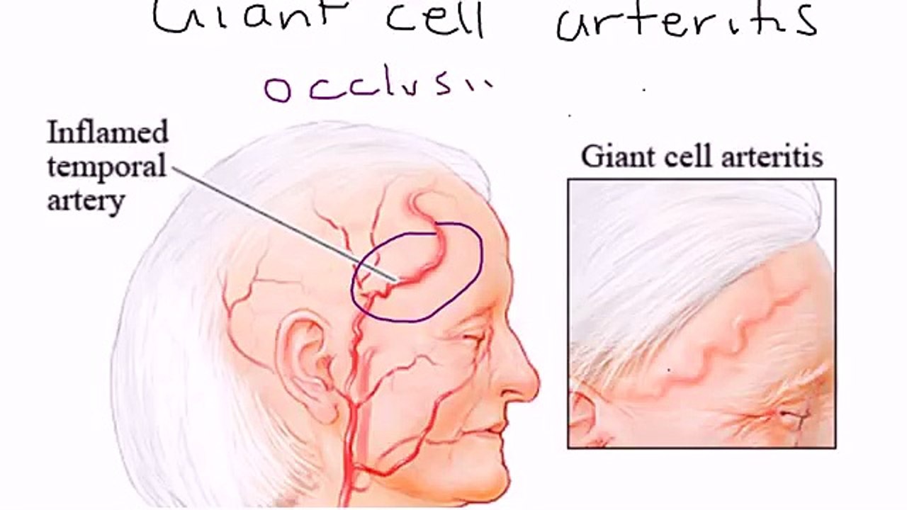 Temporal arteritis