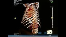 Médicos produzem cópia das costelas quebradas de um paciente com impressora 3D
