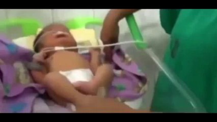 Ce bébé est né avec 2 trompes à la place du nez !