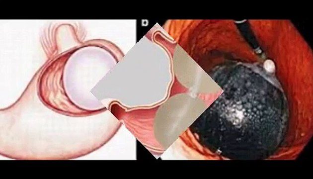 stomach dual intragastric balloon weight loss