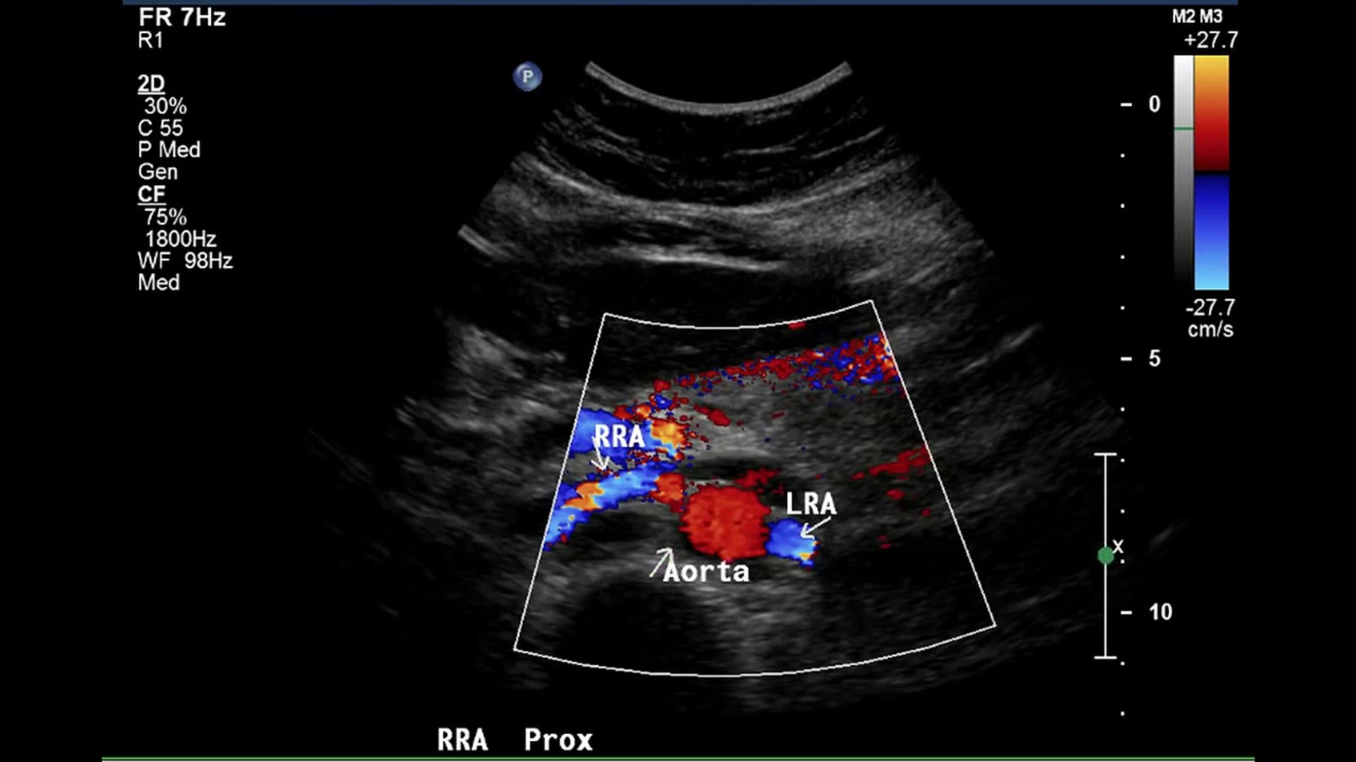 Popular Videos - Renal artery & Duplex ultrasonography