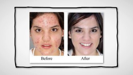 How To Get Rid of Keratosis Pilaris - New Found Cure