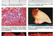 Liver Disease#1 | khmer Anatomy Liver#2 | Liver Disease 2014#2 | Liver disease in Cambodia