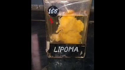 Uterus Didelphys Gross Pathology Specimen