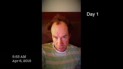 Jons Journal - Leaving for Surgery (short documentary series)