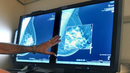 What you need to know about new mammogram guidelines