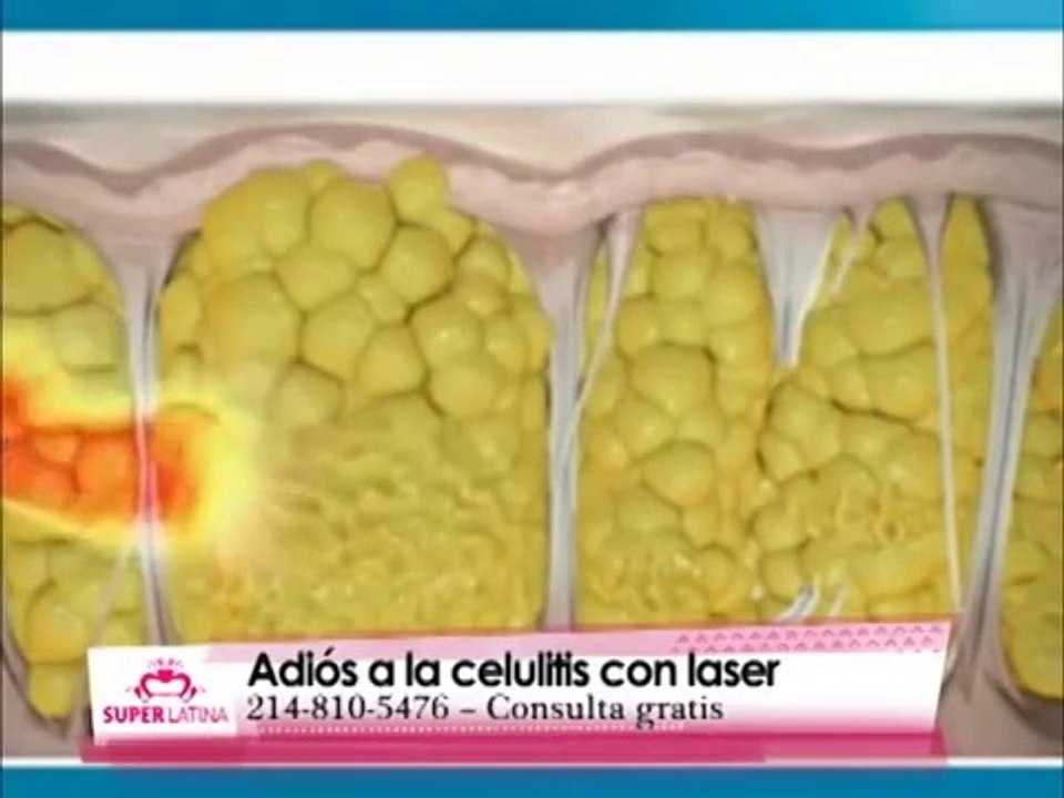 Pompis Perfectas con Laser