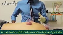 Hijama Cupping Thepary- The Best Treatment and A Forgotten Sunnah