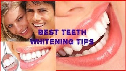 Best Teeth Whitening Tips