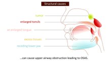 Obstructive Sleep Apnea Syndrome (OSAS) - Causes and treatment