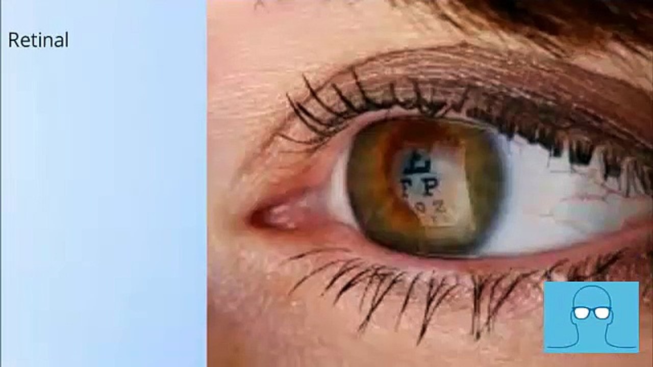 Retinal Detachment