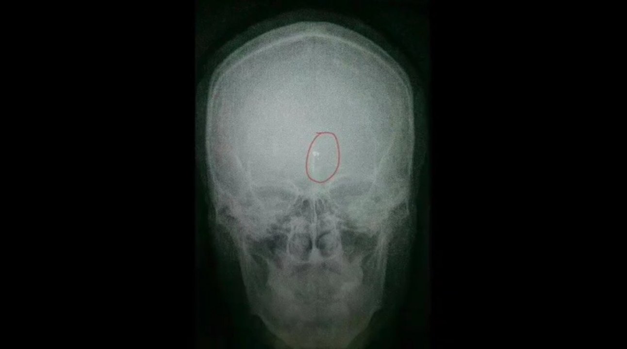 Rapper Makes a Selfie Video Seconds After Being Shot in the Head with an Ak-47 