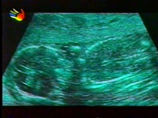 Um eterno veneno, a História do PCB -- Avisos da Natureza. Lições não Aprendidas