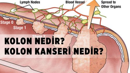 Kolon ve Kolon Kanseri Nedir?