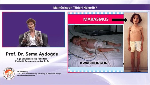 Malnutrisyon | Prof Dr Sema Aydoğdu