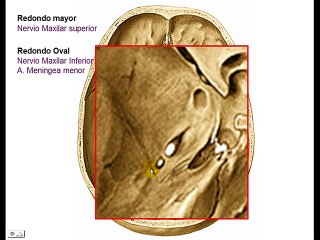 AGUJEROS DE BASE DE CRÁNEO