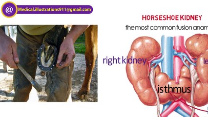 FUSION ANOMALIES : EMBRYOLOGY OF KIDNEY and UROGENITAL SYSTEM