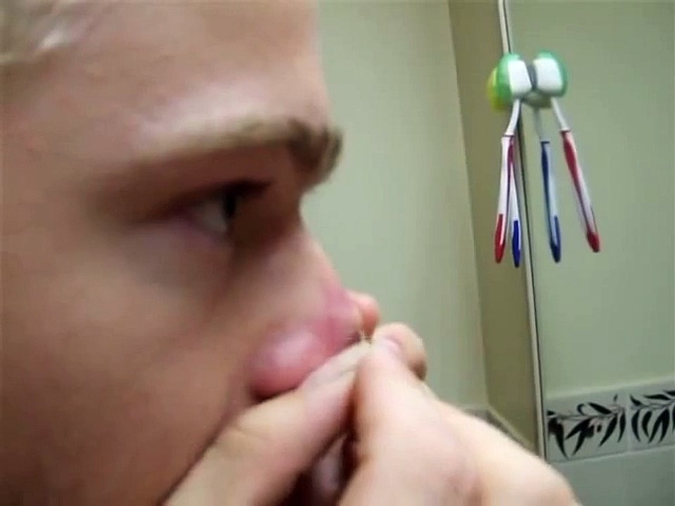 Pimple squirt on nose