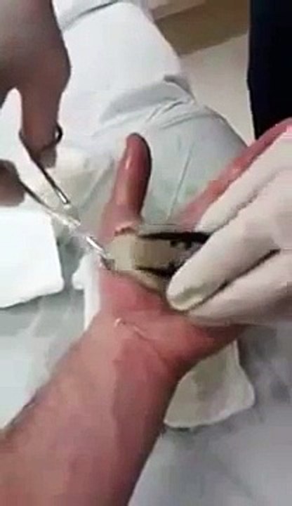 Popping giant blister