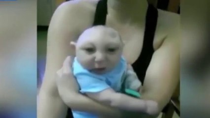 罕見平腦症寶寶奇蹟存活Rare miracle baby survived lissencephaly