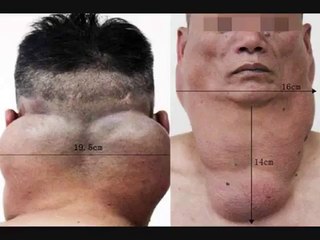 Chinese man drank 2 litres of alcohol every day