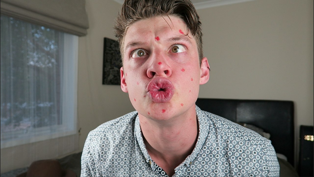 How To Cover Up Your Pimple