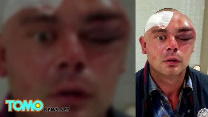 Man chomps on British DJ's face in Ibiza 'cannibal' attack caught on video