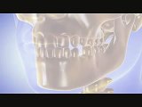 Dental implants surgery, Dental Implant procedure video by Dr Agravat Best Dental Implants Clinic Ahmedabad, India