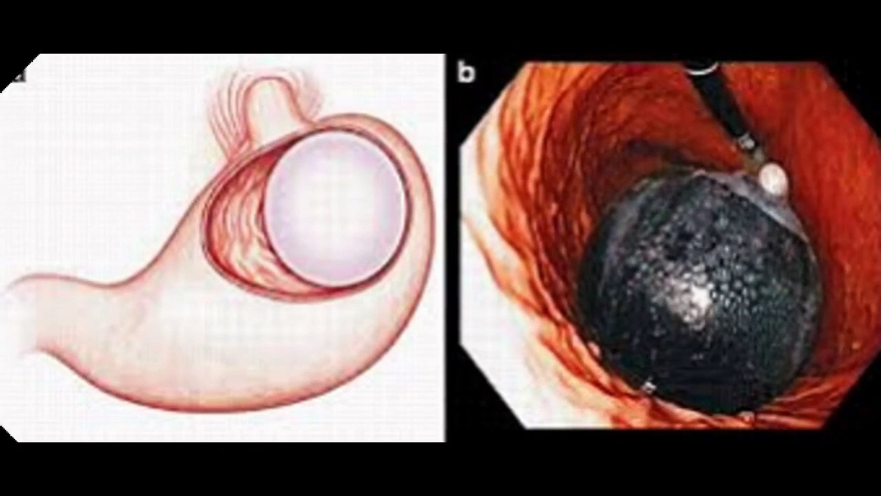 stomach balloon weight loss dual gastric bariatric balloon