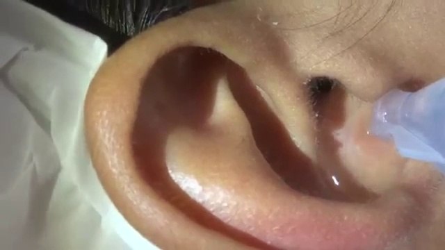 Non riusciva più a sentire, ecco cosa hanno estratto dal suo orecchio