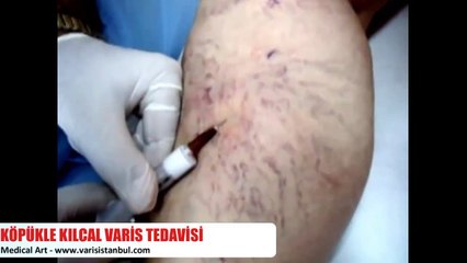 Ameliyatsız Varis Tedavisi Nasıl Yapılır? Op. Dr. Nihat AYDIN