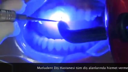 Ankara Diş Fiyatları www.mutludent.com