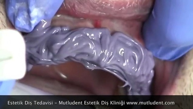 Estetik Diş Tedavisi Ankara Diş Hekimi mutludent.com/ankara-dis-hekimi.html