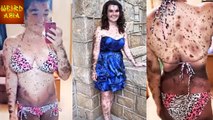 Girl Born With 100 Birth Marks Covering Her Body! | Shocking