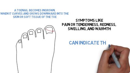 Ingrown Toenail Removal Specialists in Utah
