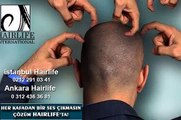 Protez Saç Fiyatları İstanbul, Protez Saç Yaptırmak İstiyorum, Protez Saç Yorumları