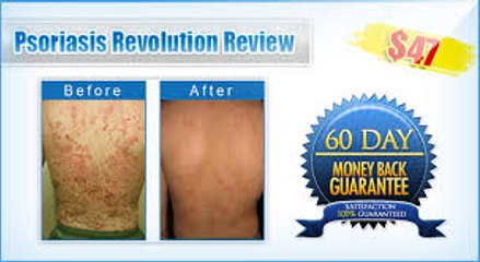 Psoriasis Revolution Review + 8 FREE Bonuses