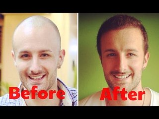 WORST Thing About A Hair Transplant - FAQ