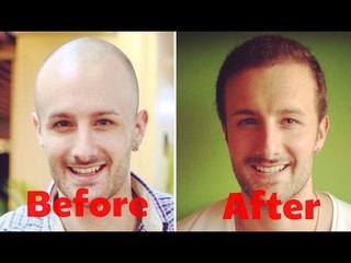 Hair Transplant Surgery - FULL DISCLOSURE pt. 2 - (Post Operation)