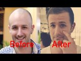 World's BEST Hair Transplant Surgeons!